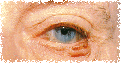 Carcinoma