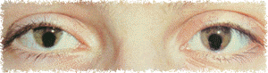 Coloboma