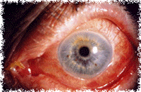 Conjuntivite