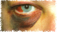 Hemorragia Subconjuntival