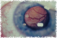 Retinoblastoma