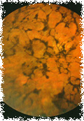 Retinose Pigmentar